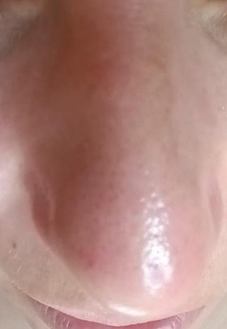 Kombinētā sejas tīrīšana: pēc