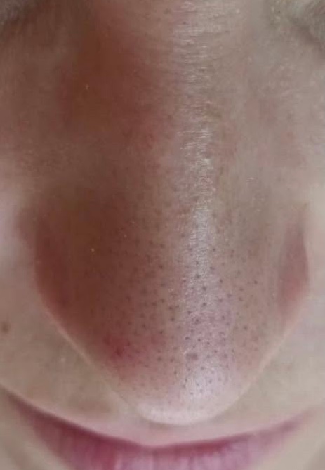 Kombinētā sejas tīrīšana: pirms