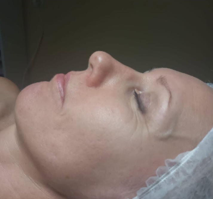 Dermapen mikroadatu terapija: pirms procedūras